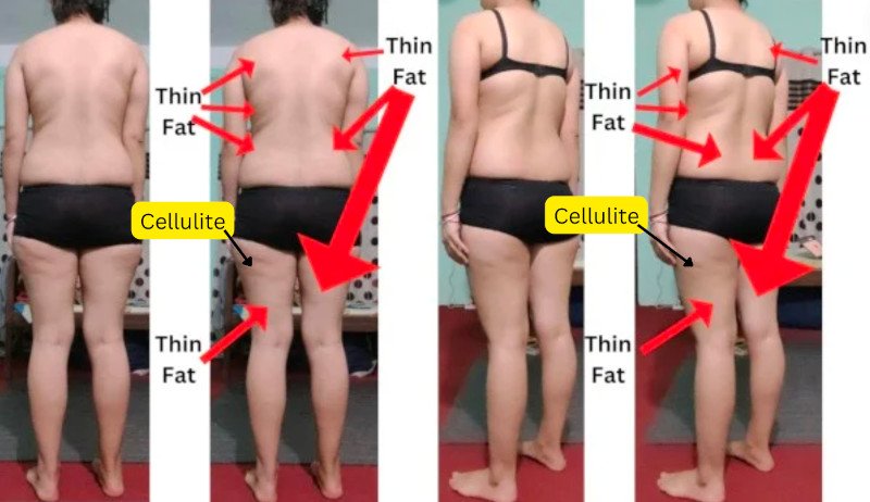Skinny Fat, Thin Fat and Cellulite Tissue - Official Scientific Body Type Quiz - 6 Types of Skinny Fat (Cellulite, Thin Fat, Loose Skin, Saggy Skin, Crepey Skin, Normal Weight Obesity)